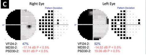 Visual Field Loss a High Predictor in Stroke Study