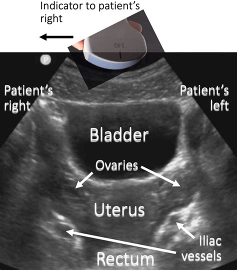 Pelvic Ultrasound: Transverse Anatomy