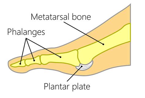 Podiatry Centre for Plantar Plate Tear in Singapore