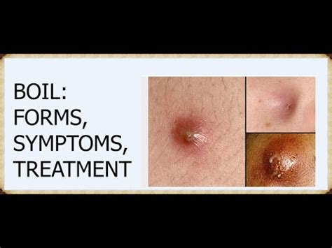 What Is a Boil,FORMS,SYMPTOMS,TREATMENT - YouTube