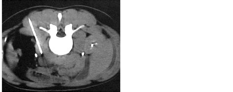 Contrast-Enhanced CT-Guided Core Biopsy of Retroperitoneal Masses