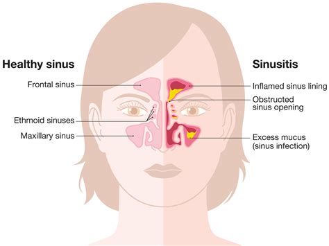 Sinus Infection Thomasville | Acute Sinusitis Lexington