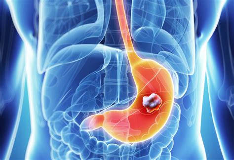 Stomach cancer: causes, warning signs, and treatment