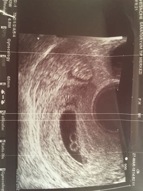 8 Week Ultrasound Fraternal Twins