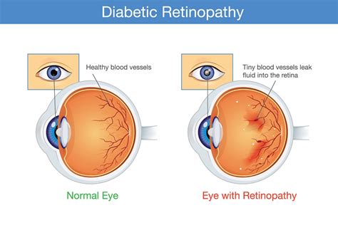 Diabetic Retinopathy Causes, Symptoms, Prevention, Diagnosis and Treatment - Breathe Well-Being