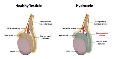 Epididymal Head Cyst