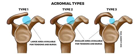 Impingement & Bursitis - Dr Paul Jarrett, Orthopaedic Surgeon Perth