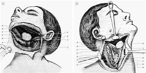 Neck Dissection: An Operation in Evolution: Hayes Martin Lecture ...