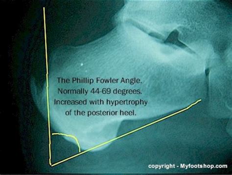 Haglund's Deformity | Causes and treatment options | MyFootShop.com