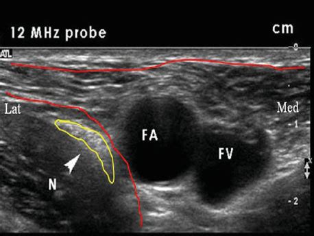 9b Ultrasound image of femoral anatomy. FA femoral artery, FV femoral...