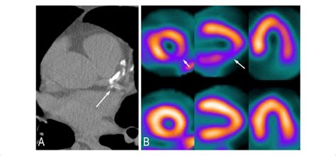 Patient with calcium score 101-400. (A) Moderate quantity of calcified... | Download Scientific ...