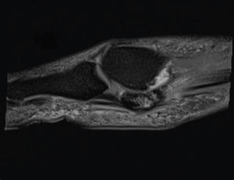 Magnetic resonance imaging of the left foot demonstrating bipartite... | Download Scientific Diagram