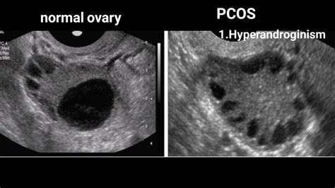 Follicle Detection And Ovarian Classification In Digital, 60% OFF