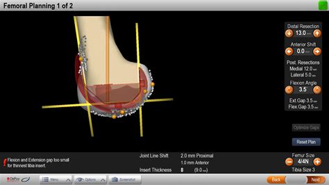 computer assisted total knee replacement surgery in chennai, total knee ...