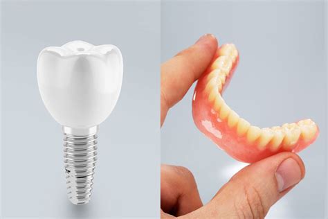 Dental Implants vs Dentures (Pros & Cons of Each) - Elegant Dental Care