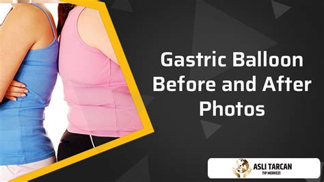 Gastric Balloon Before and After Photos