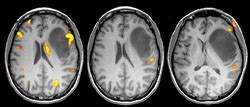 MRI Contrast Agent Dye (Omniscan & Magnevist - Gadolinium)