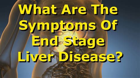 What Are The Symptoms Of End-Stage Liver Disease? - YouTube