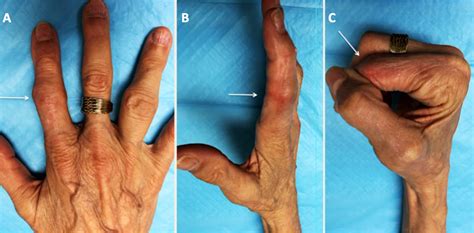 AAHS - Long Term Successful Wrist and Finger Joint Arthroplasty Using Cadaveric Meniscus for ...