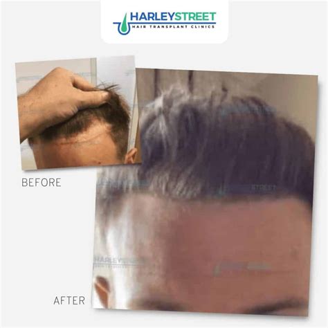 Hair Transplant for a Receding Hairline - Harley Street HTC