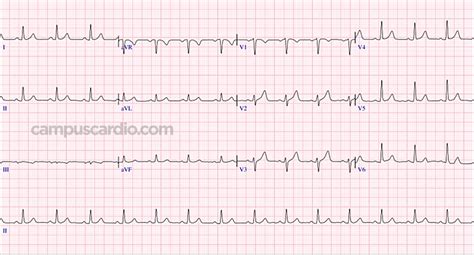 Electrocardiograma