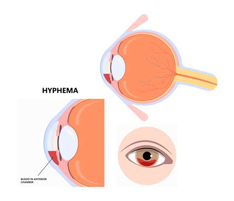 What is Hyphema | D.r Michael Ahdoot MD