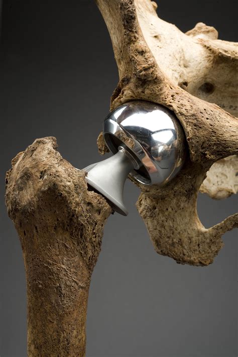 Right femoral head replacement | Smithsonian Institution