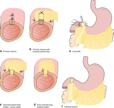 Strategies to improve the outcome of emergency surgery for perforated peptic ulcer - Søreide ...