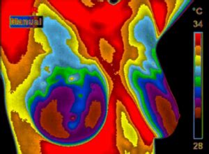 Breast Thermography at Cedar Wood Natural Health Center