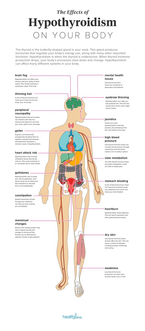 Hypothyroidism Chart