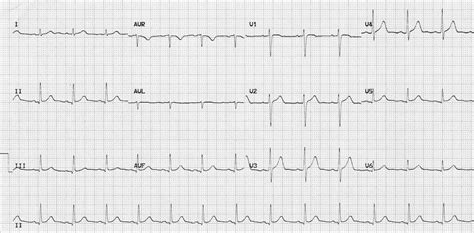 Normal Sinus Rhythm • LITFL Medical Blog • ECG Library Basics