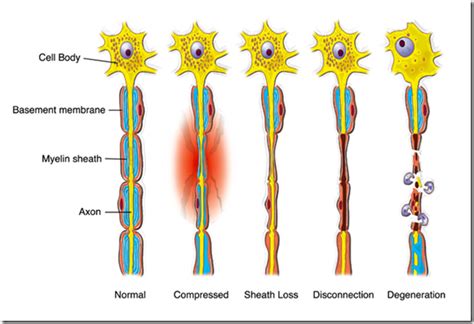 Degeneration & regeneration of peripheral nerves - Medatrio