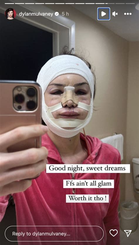 Trans influencer Dylan Mulvaney reveals the results of her facial feminization surgery in a ...