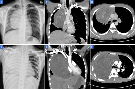 Chest radiography and CT of the patient. (a) Chest X-ray showed a large... | Download Scientific ...