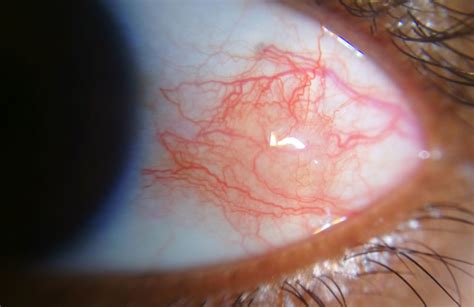 Episcleritis, nodular episcleritis, causes, signs, symptoms & treatment