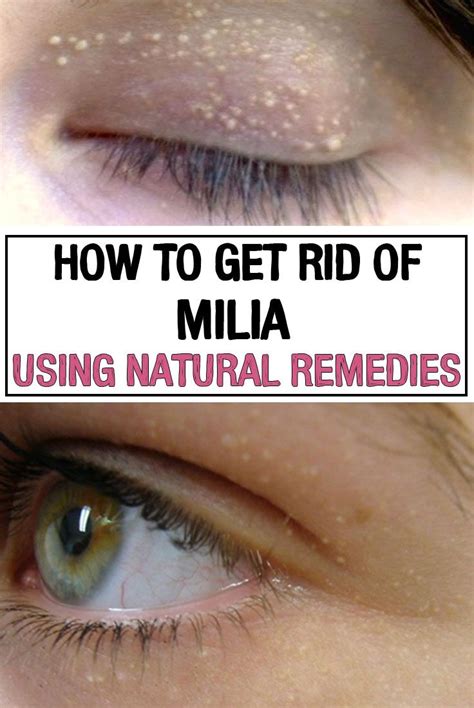 How To Get Rid Of Milia At Home Fast