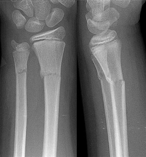 Below-elbow cast for metaphyseal both-bone fractures of the distal forearm in children: A ...