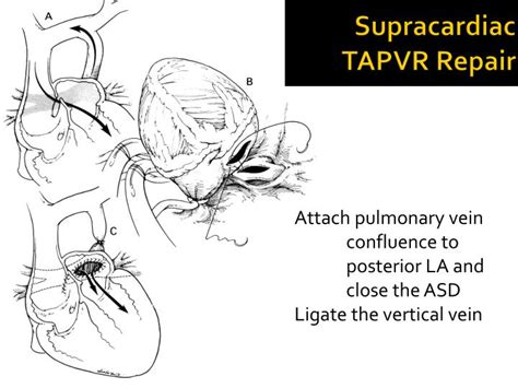 PPT - Cardiac Surgical Anomalies in the Neonate PowerPoint Presentation - ID:3218840