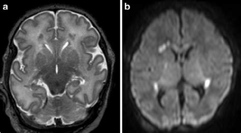 Full-term infant with punctate white matter lesions seen as low signal... | Download Scientific ...