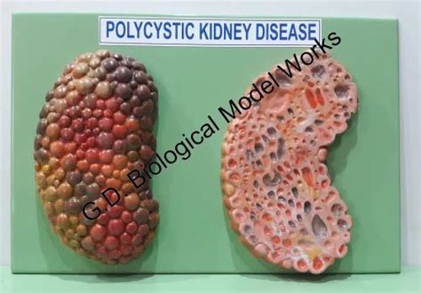 Polycystic Kidney Disease Pathology Model at Rs 2500/piece | Pathology Model in Ambala | ID ...