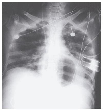 Esophageal rupture due to Sengstaken-Blakemore tube misplacement