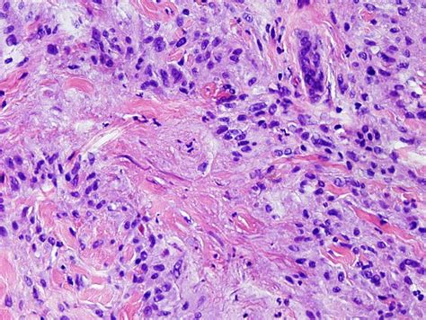 Epithelioid sarcoma mimics GA with the necrobiosis. It can also be confused with carcinoma, and ...