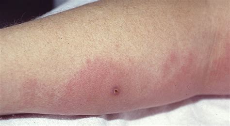 Cellulitis and Erysipelis