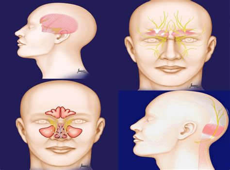 THE SURGICAL TREATMENT OF MIGRAINE HEADACHES (MIGRAINE SURGERY). HOW ...