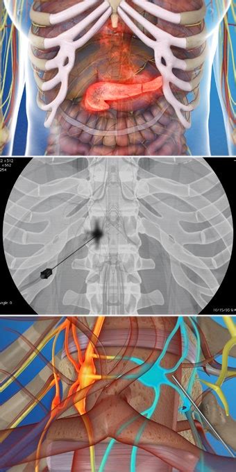 Celiac Plexus Block – Pain Specialists of Southern Oregon