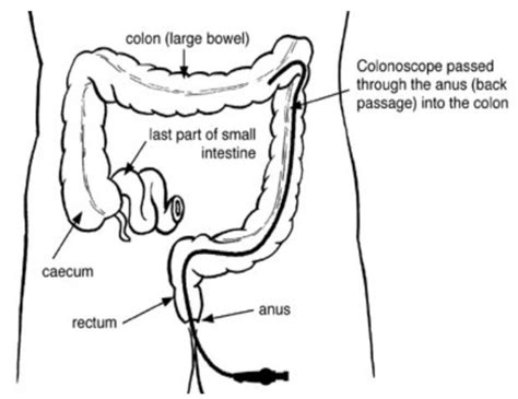 Colonoscopy - The procedure explained - Milton Keynes University Hospital