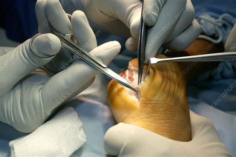 Foot reconstruction surgery - Stock Image - C053/0280 - Science Photo ...