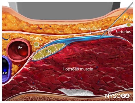 Ultrasound-Guided Fascia Iliaca Nerve Block - NYSORA | NYSORA