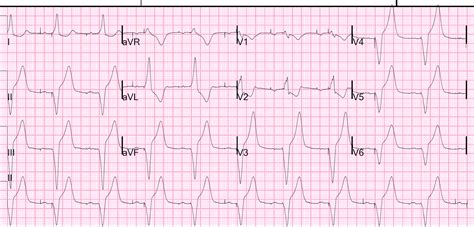 Dr. Smith's ECG Blog: Neck and Jaw Pain in a patient with a Pacemaker ...