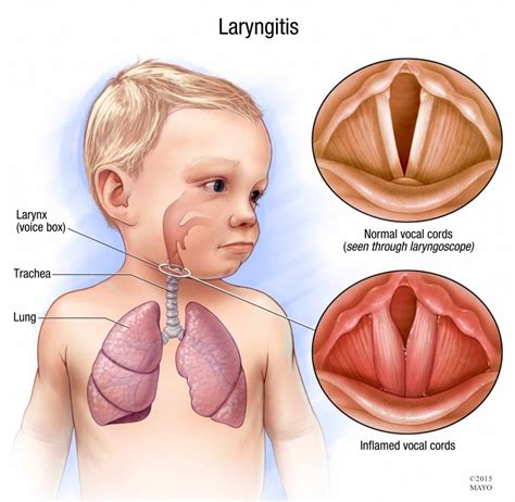 Laryngitis | Diseases and Their Cures Wikia | FANDOM powered by Wikia